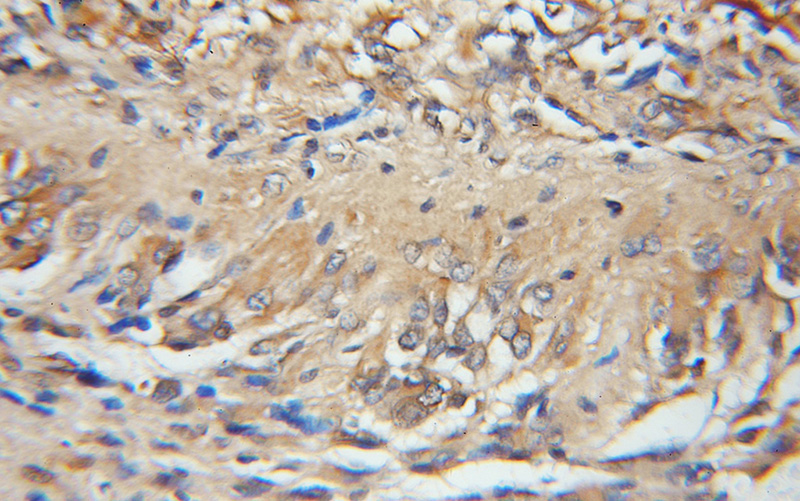 Immunohistochemical of paraffin-embedded human gliomas using Catalog No:108170(ARPP-19 antibody) at dilution of 1:50 (under 10x lens)