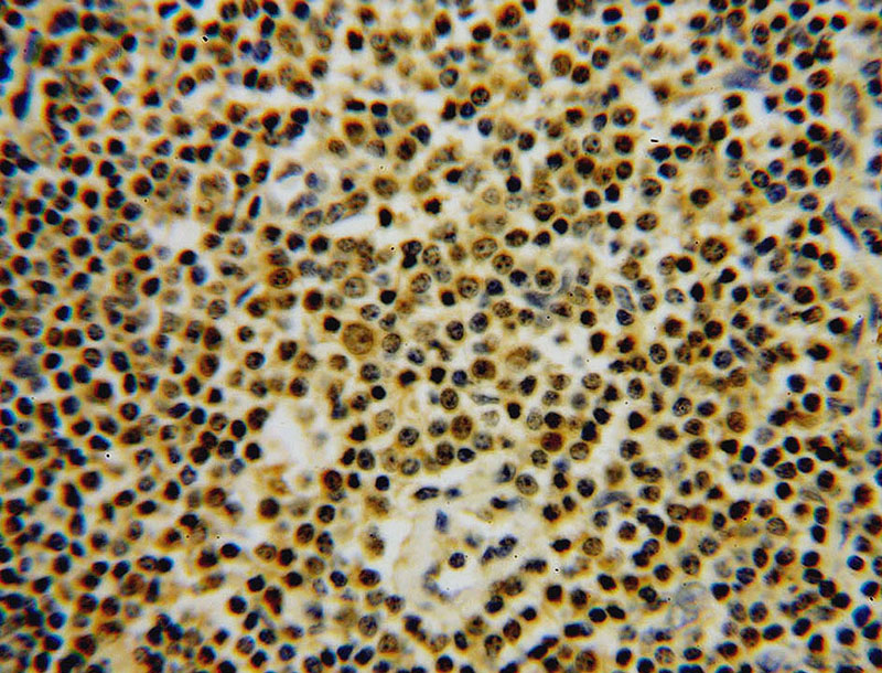 Immunohistochemical of paraffin-embedded human lymphoma using Catalog No:111096(GMDS antibody) at dilution of 1:50 (under 40x lens)