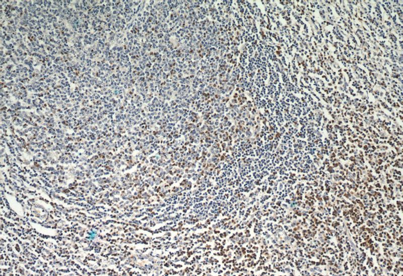 Immunohistochemical of paraffin-embedded human tonsillitis using Catalog No:116904(ZAP70 antibody) at dilution of 1:50 (under 10x lens)