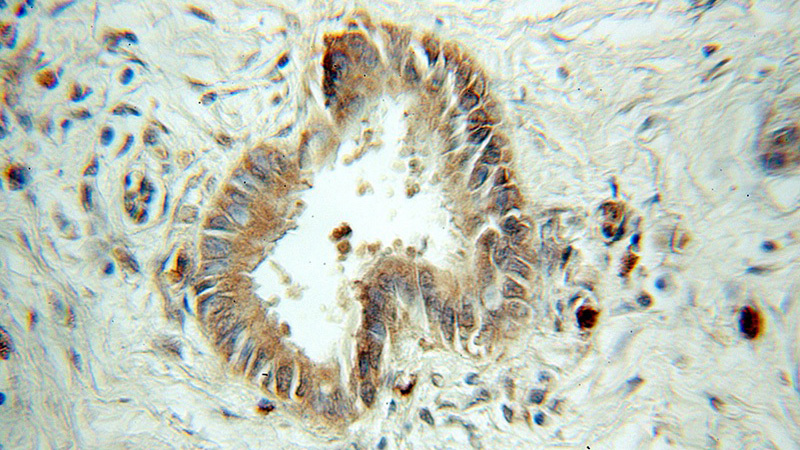 Immunohistochemical of paraffin-embedded human pancreas cancer using Catalog No:115087(SEC61B antibody) at dilution of 1:50 (under 10x lens)