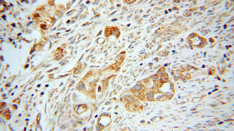 Immunohistochemical of paraffin-embedded human endometrial cancer using Catalog No:112057(KNG1 antibody) at dilution of 1:50 (under 40x lens)