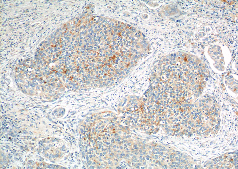 Immunohistochemistry of paraffin-embedded human cervical cancer tissue slide using Catalog No:115146(SFRP4 Antibody) at dilution of 1:200 (under 10x lens).