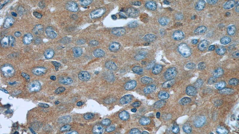 Immunohistochemistry of paraffin-embedded human lung cancer tissue slide using Catalog No:114984(SCAP Antibody) at dilution of 1:50 (under 40x lens)