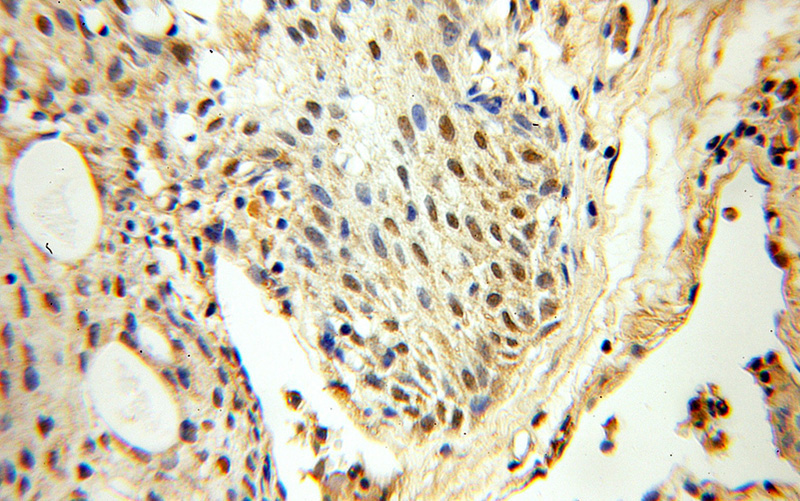 Immunohistochemical of paraffin-embedded human prostate cancer using Catalog No:110451(FAF1 antibody) at dilution of 1:50 (under 40x lens)