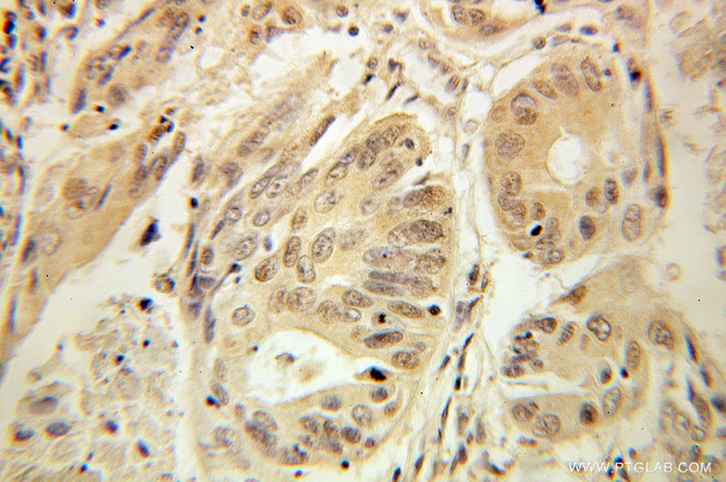 Immunohistochemical of paraffin-embedded human colon cancer using Catalog No:114543(RANGRF antibody) at dilution of 1:100 (under 10x lens)