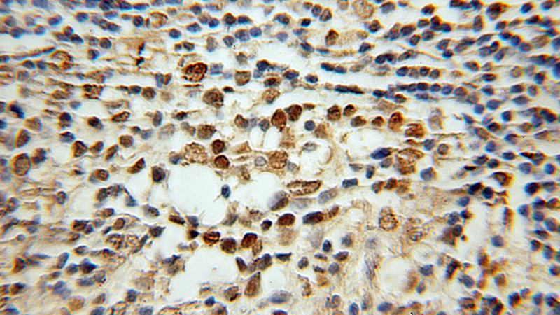 Immunohistochemical of paraffin-embedded human lymphoma using Catalog No:111404(H2AFX antibody) at dilution of 1:100 (under 10x lens)