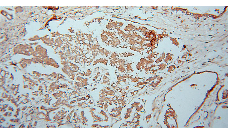 Immunohistochemical of paraffin-embedded human ovary tumor using Catalog No:117068(ATXN10 antibody) at dilution of 1:100 (under 10x lens)