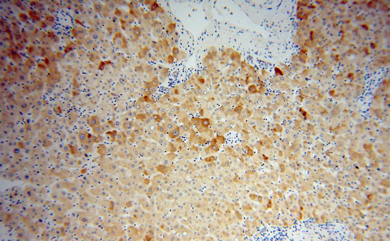 Immunohistochemical of paraffin-embedded human liver cancer using Catalog No:110941(GEMIN8 antibody) at dilution of 1:50 (under 10x lens)