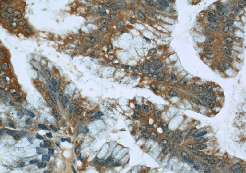 Immunohistochemical of paraffin-embedded human ovary tumor using Catalog No:115707(STIM1 antibody) at dilution of 1:50 (under 40x lens)