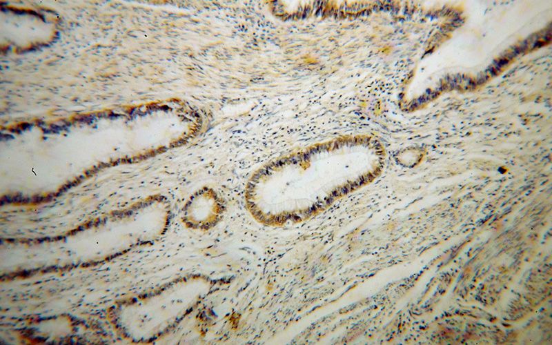 Immunohistochemical of paraffin-embedded human colon cancer using Catalog No:114815(RPL14 antibody) at dilution of 1:100 (under 10x lens)