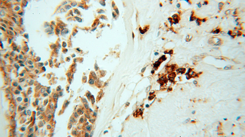 Immunohistochemical of paraffin-embedded human breast cancer using Catalog No:111222(HSP90B1 antibody) at dilution of 1:50 (under 40x lens)