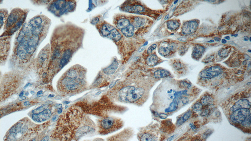 Immunohistochemistry of paraffin-embedded human lung cancer slide using Catalog No:116098(TMEM139 Antibody) at dilution of 1:50