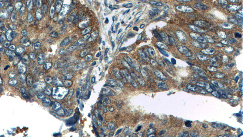 Immunohistochemistry of paraffin-embedded human colon cancer tissue slide using Catalog No:116220(TPT1 Antibody) at dilution of 1:200 (under 40x lens).