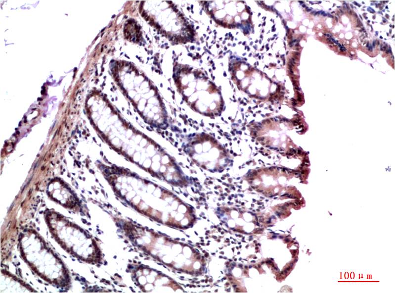 Immunohistochemical analysis of paraffin-embedded Human Colon Carcinoma Tissue using HP-1γ  Mouse mAb diluted at 1:200.