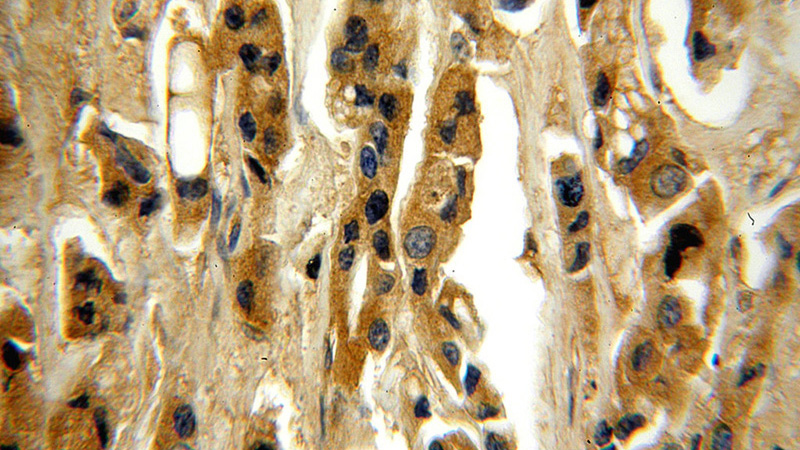 Immunohistochemical of paraffin-embedded human breast cancer using Catalog No:112698(MMP13 antibody) at dilution of 1:50 (under 40x lens)