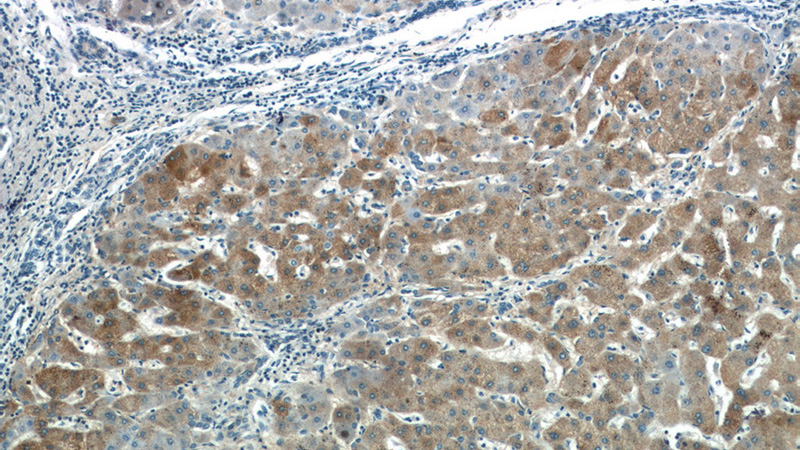 Immunohistochemistry of paraffin-embedded human hepatocirrhosis tissue slide using Catalog No:113571(PANK3 Antibody) at dilution of 1:50 (under 10x lens)