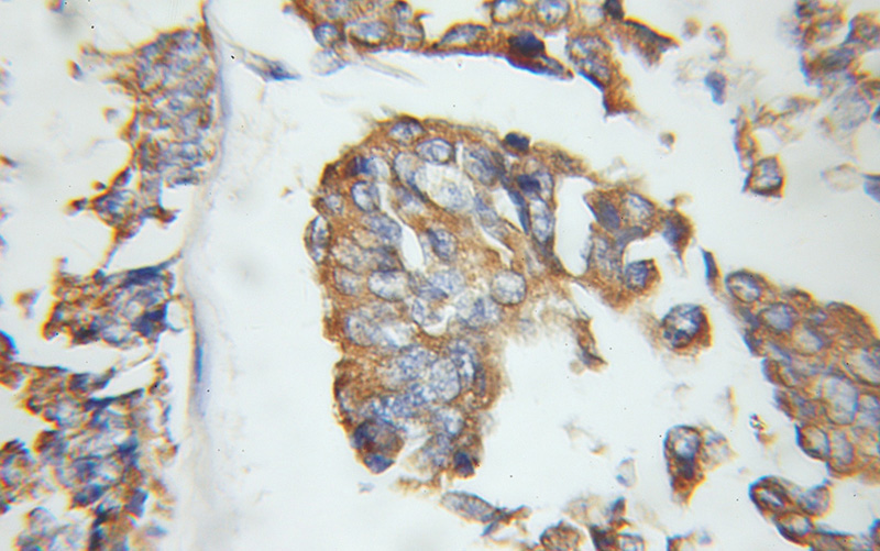 Immunohistochemical of paraffin-embedded human breast cancer using Catalog No:110198(EIF3J antibody) at dilution of 1:100 (under 10x lens)