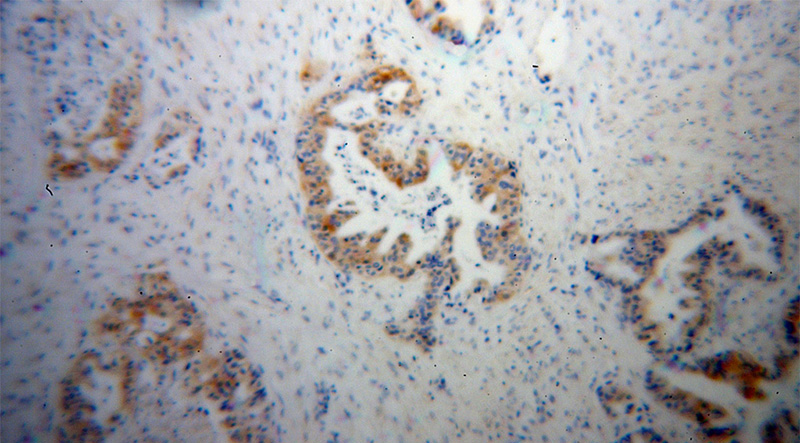 Immunohistochemical of paraffin-embedded human stomach cancer using Catalog No:111165(GSDMB antibody) at dilution of 1:50 (under 10x lens)