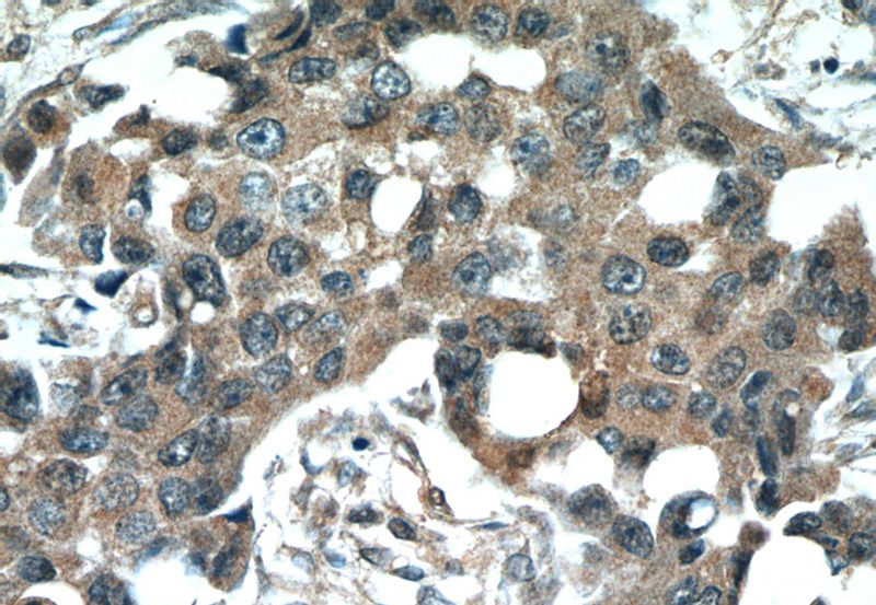 Immunohistochemical of paraffin-embedded human breast cancer using Catalog No:108918(CAMK2D antibody) at dilution of 1:50 (under 40x lens)
