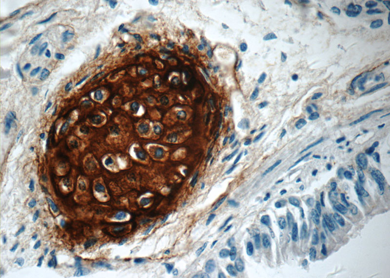 Immunohistochemistry of paraffin-embedded human lung tissue slide using Catalog No:107829(ACAN Antibody) at dilution of 1:400 (under 40x lens)