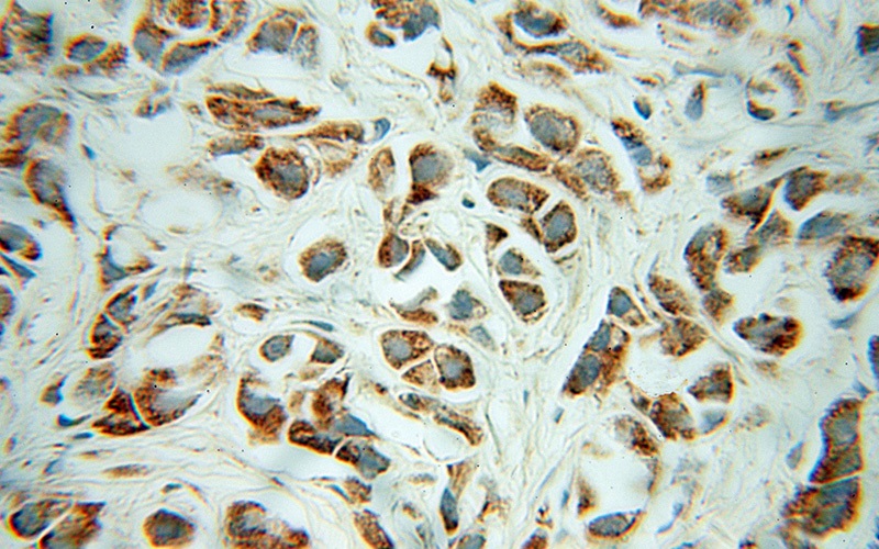 Immunohistochemical of paraffin-embedded human prostate cancer using Catalog No:109279(CHRNA3 antibody) at dilution of 1:50 (under 40x lens)