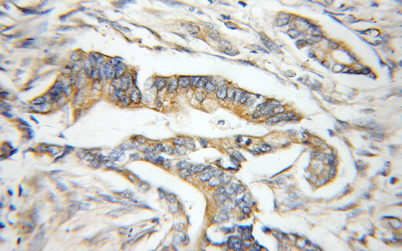 Immunohistochemical of paraffin-embedded human pancreas cancer using Catalog No:112796(MTRF1 antibody) at dilution of 1:50 (under 10x lens)