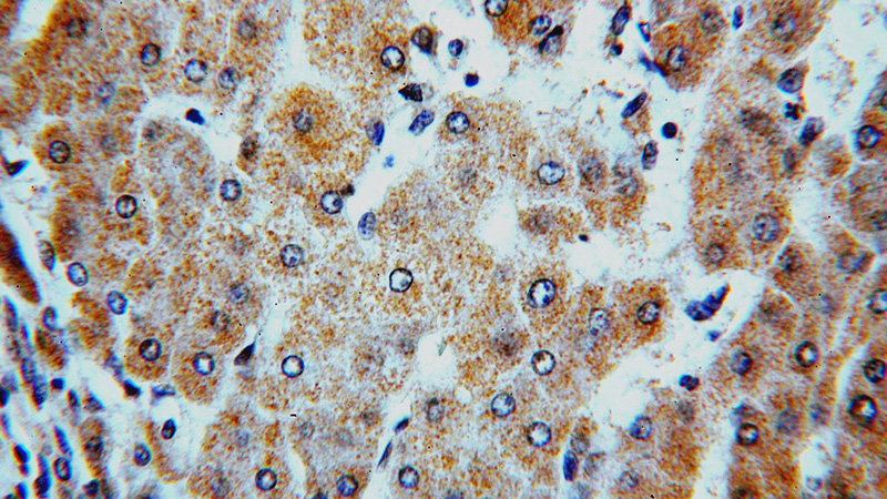 Immunohistochemical of paraffin-embedded human hepatocirrhosis using Catalog No:111493(HMP19 antibody) at dilution of 1:50 (under 40x lens)