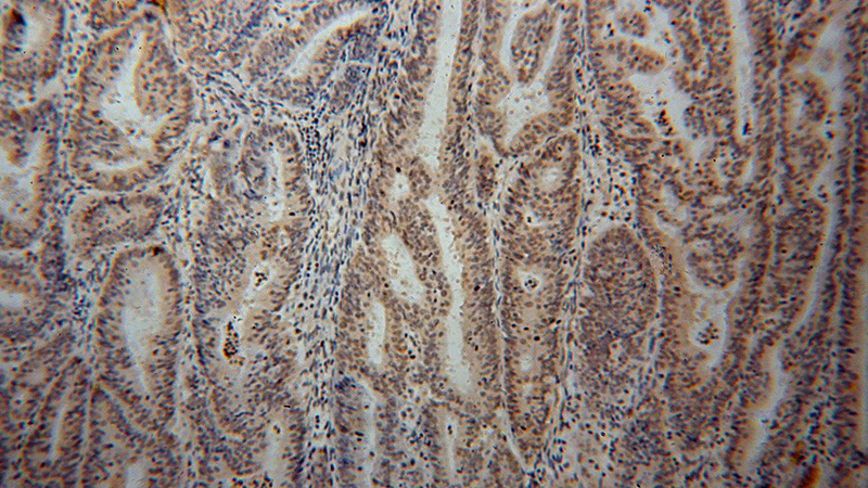 Immunohistochemical of paraffin-embedded human endometrial cancer using Catalog No:115134(SF3A2 antibody) at dilution of 1:50 (under 10x lens)