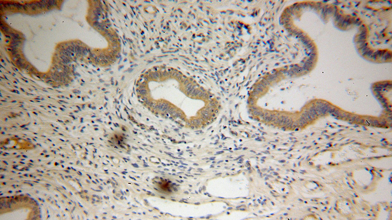 Immunohistochemical of paraffin-embedded human cervical cancer using Catalog No:111097(GMEB2 antibody) at dilution of 1:100 (under 10x lens)