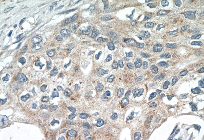 Immunohistochemistry of paraffin-embedded human cervical cancer tissue slide using Catalog No:115650(SPRY4 Antibody) at dilution of 1:50 (under 40x lens)