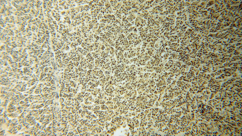 Immunohistochemical of paraffin-embedded human lymphoma using Catalog No:116144(TNIP1 antibody) at dilution of 1:50 (under 10x lens)