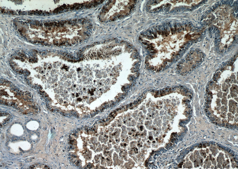 Immunohistochemical of paraffin-embedded human prostate hyperplasia using Catalog No:108965(CCDC153 antibody) at dilution of 1:50 (under 10x lens)