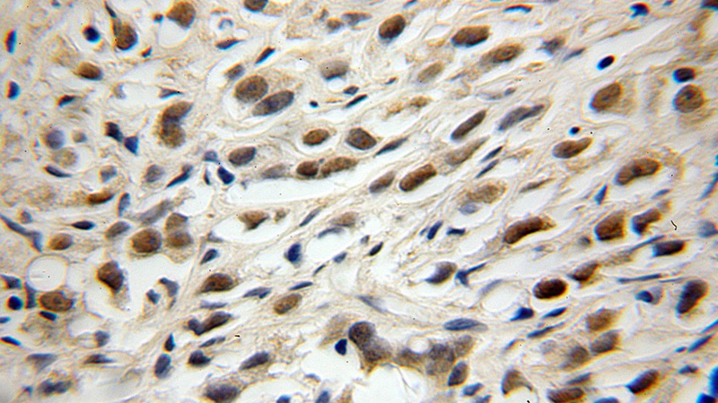 Immunohistochemical of paraffin-embedded human gliomas using Catalog No:116324(TRIM69 antibody) at dilution of 1:100 (under 10x lens)