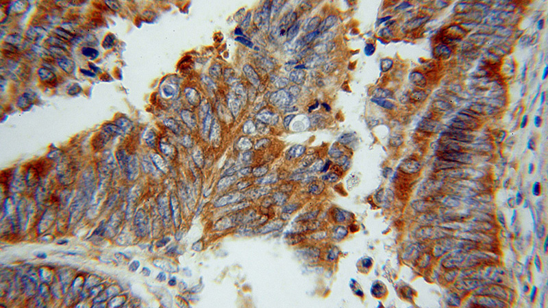 Immunohistochemical of paraffin-embedded human colon cancer using Catalog No:114827(RPS12 antibody) at dilution of 1:50 (under 40x lens)