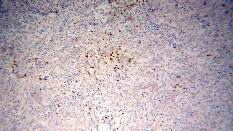 Immunohistochemical of paraffin-embedded human breast cancer using Catalog No:113852(PRKCI antibody) at dilution of 1:100 (under 10x lens)