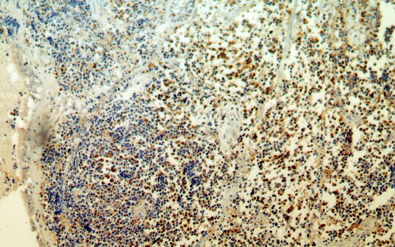 Immunohistochemical of paraffin-embedded human lung cancer using Catalog No:109480(COTL1 antibody) at dilution of 1:50 (under 10x lens)