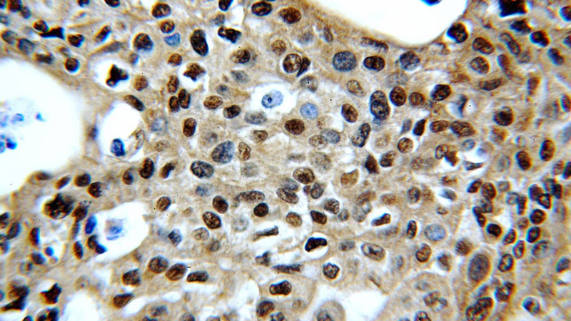 Immunohistochemical of paraffin-embedded human cervical cancer using Catalog No:109157(CDC2-Specific antibody) at dilution of 1:50 (under 40x lens)