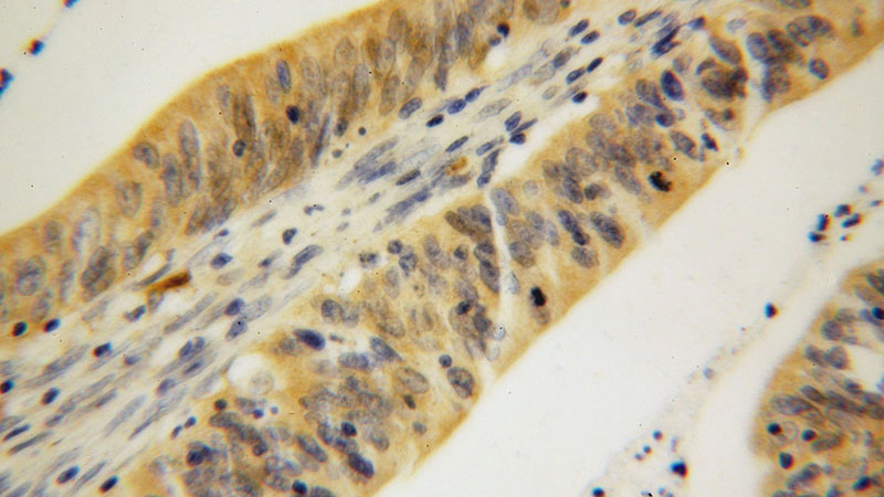 Immunohistochemical of paraffin-embedded human colon cancer using Catalog No:111103(GMPR antibody) at dilution of 1:100 (under 40x lens)