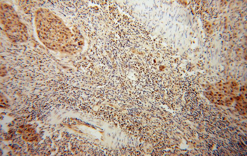 Immunohistochemical of paraffin-embedded human cervical cancer using Catalog No:115904(TCF12 antibody) at dilution of 1:50 (under 10x lens)