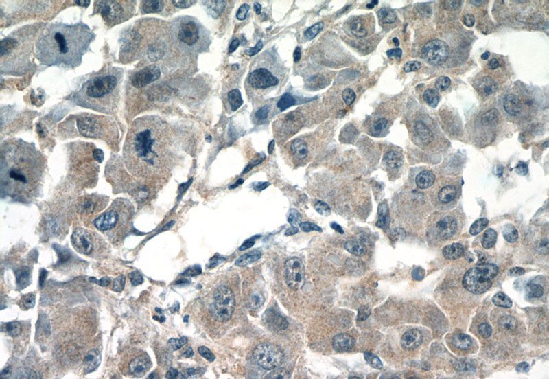 Immunohistochemistry of paraffin-embedded human liver cancer tissue slide using Catalog No:109506(CPEB1 Antibody) at dilution of 1:50 (under 40x lens)