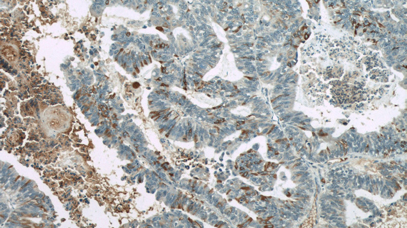 Immunohistochemical of paraffin-embedded human ovary tumor using Catalog No:107433(MUC16,CA125 antibody) at dilution of 1:50 (under 10x lens)