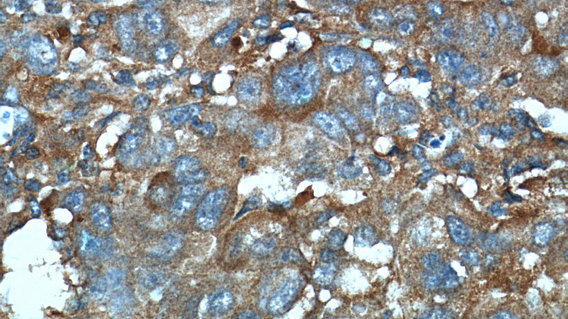 Immunohistochemistry of paraffin-embedded human liver cancer tissue slide using Catalog No:111689(IGFBP7 Antibody) at dilution of 1:50 (under 40x lens)