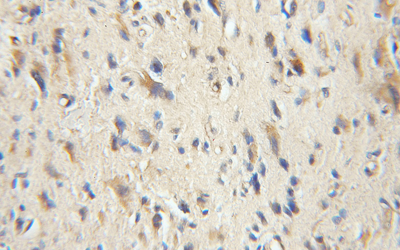 Immunohistochemical of paraffin-embedded human gliomas using Catalog No:109168(CDK9 antibody) at dilution of 1:50 (under 40x lens)
