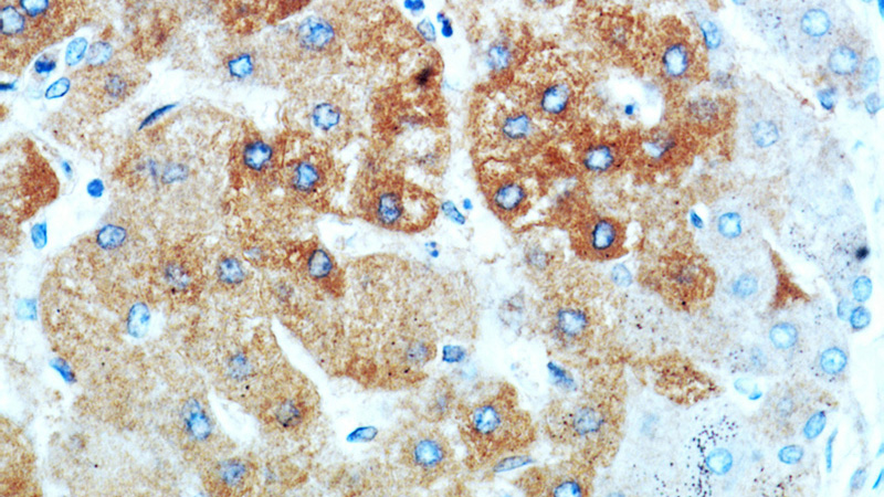 Immunohistochemical of paraffin-embedded human hepatocirrhosis using Catalog No:115057(SAMM50 antibody) at dilution of 1:100 (under 40x lens)