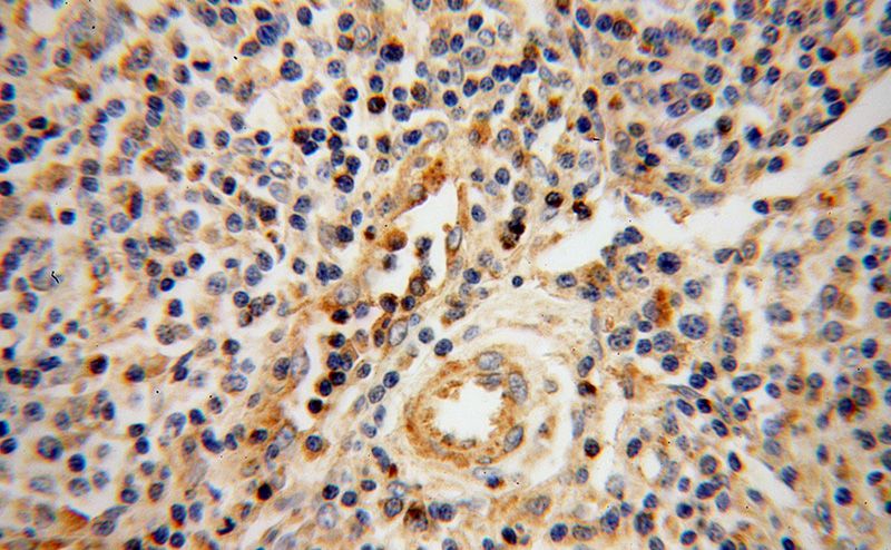 Immunohistochemical of paraffin-embedded human lymphoma using Catalog No:111160(GZMA antibody) at dilution of 1:50 (under 40x lens)