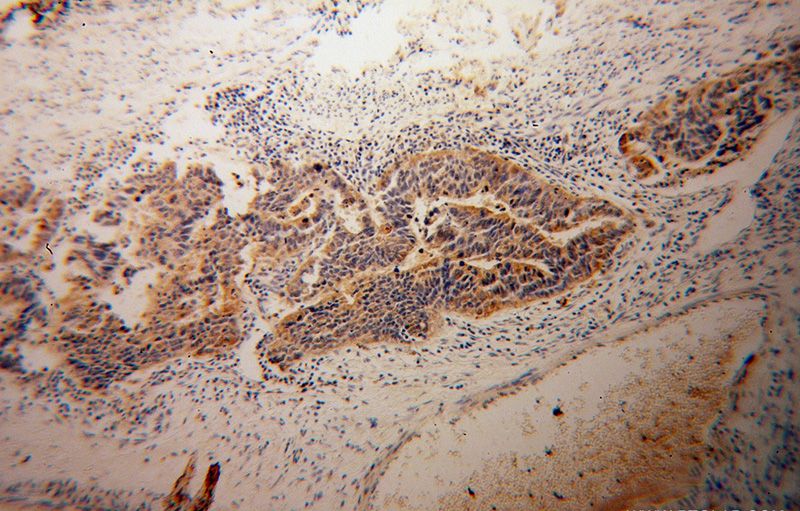 Immunohistochemical of paraffin-embedded human osteosarcoma using Catalog No:112187(LDHD antibody) at dilution of 1:50 (under 10x lens)