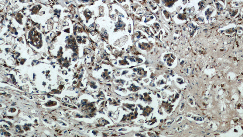 Immunohistochemical of paraffin-embedded human breast cancer using Catalog No:108887(CTSB antibody) at dilution of 1:50 (under 10x lens)