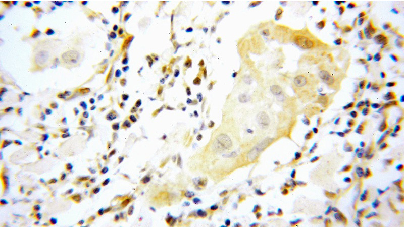 Immunohistochemical of paraffin-embedded human cervical cancer using Catalog No:115687(STAT3 antibody) at dilution of 1:100 (under 40x lens)