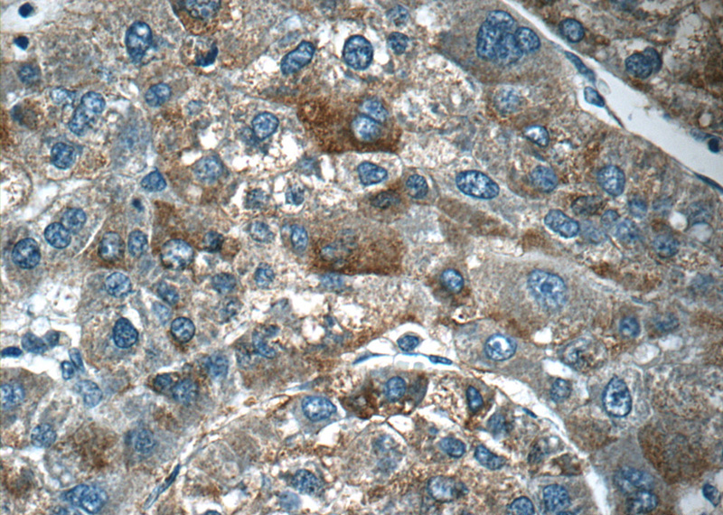 Immunohistochemistry of paraffin-embedded human liver cancer tissue slide using Catalog No:108052(ANGPT2 Antibody) at dilution of 1:50 (under 40x lens)