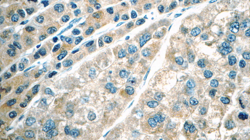 Immunohistochemistry of paraffin-embedded human liver cancer tissue slide using Catalog No:107695(ACSL1 Antibody) at dilution of 1:50 (under 40x lens)